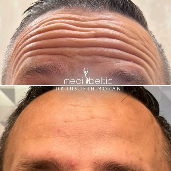 Tratamiento de Bótox en Guayaquil