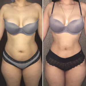 Cirugías corporales - Minilipo