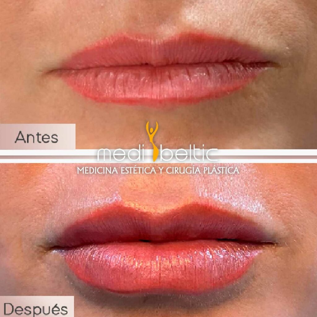 modelado de labios