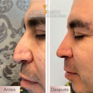 rinomodelación con ácido hialurónico resultados antes y después