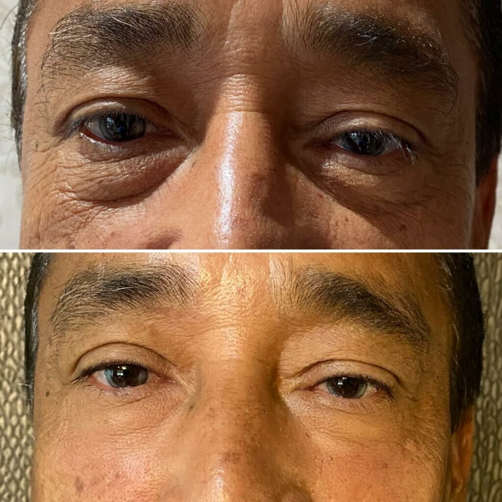relleno de ojeras con ácido hialurónico resultados antes y después