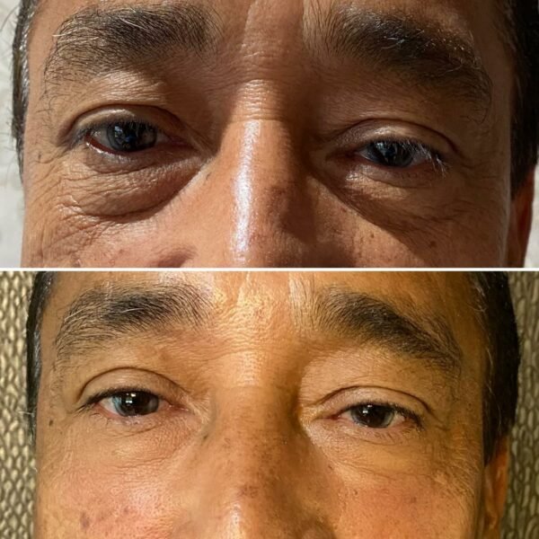 relleno de ojeras con ácido hialurónico resultados antes y después