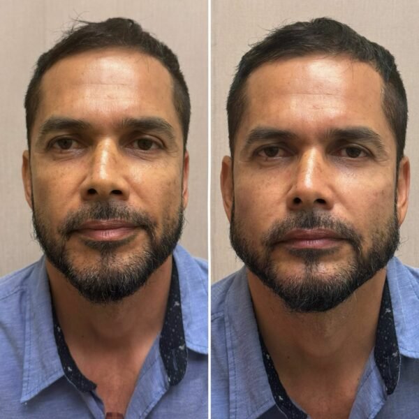 Armonización Facial - Imagen 3