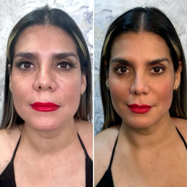 Armonización Facial - Imagen 2