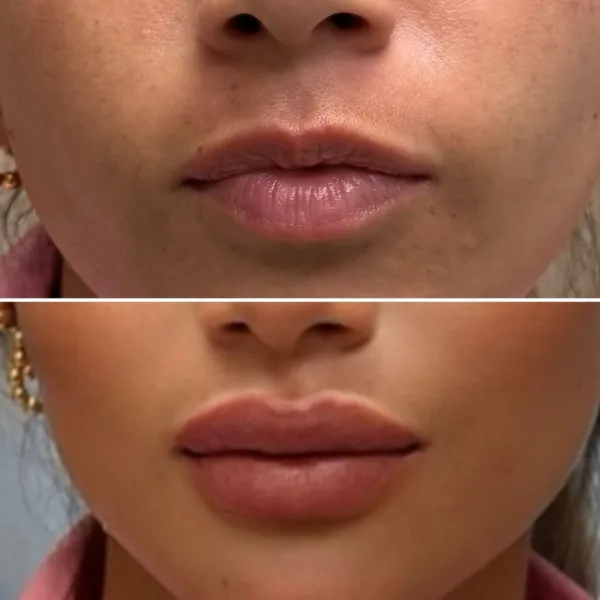 Ácido hialurónico en labios - Imagen 4