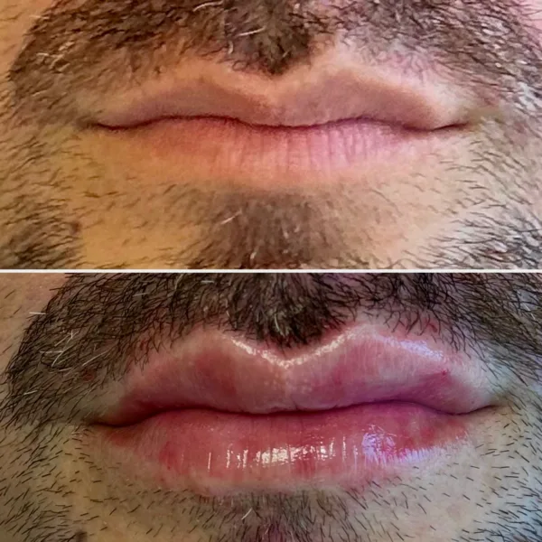 Ácido hialurónico en labios - Imagen 3