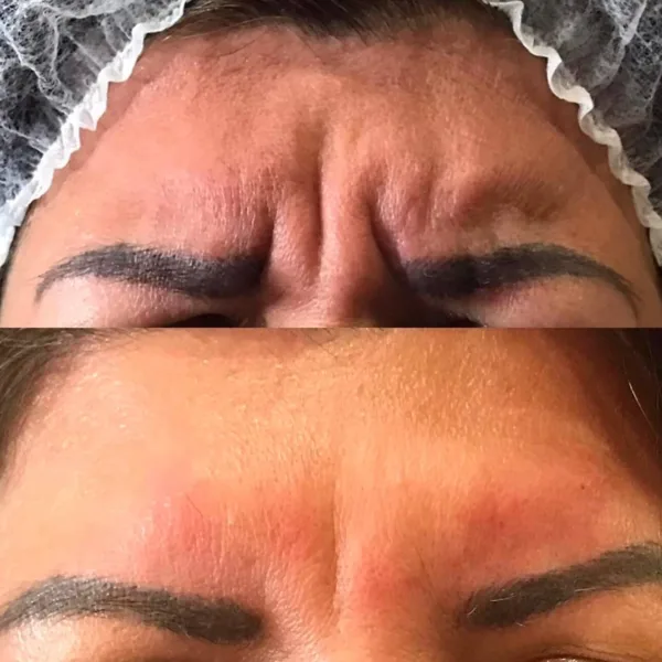 toxina botulinica entrecejo precio Guayaquil