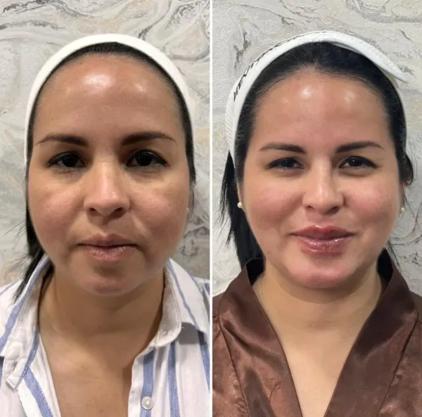Armonización Facial - Imagen 5
