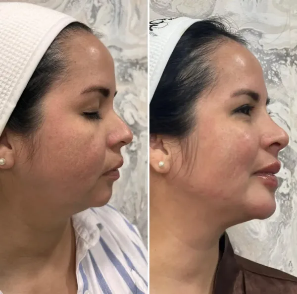 Armonización Facial - Imagen 6