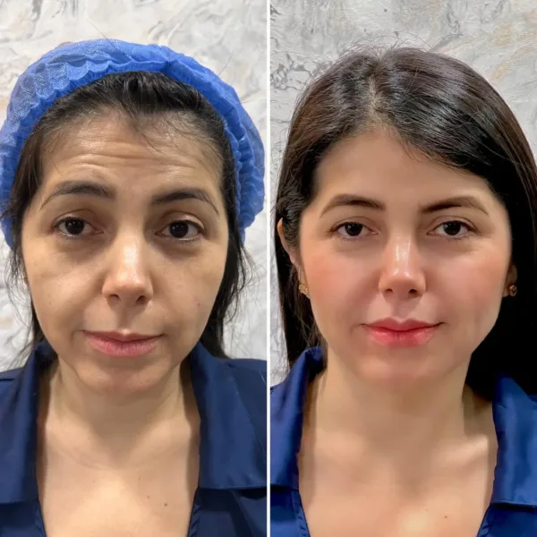 Armonización Facial - Imagen 4