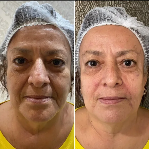 CFU Elife: Rejuvenecimiento facial y corporal no invasivo - Imagen 4