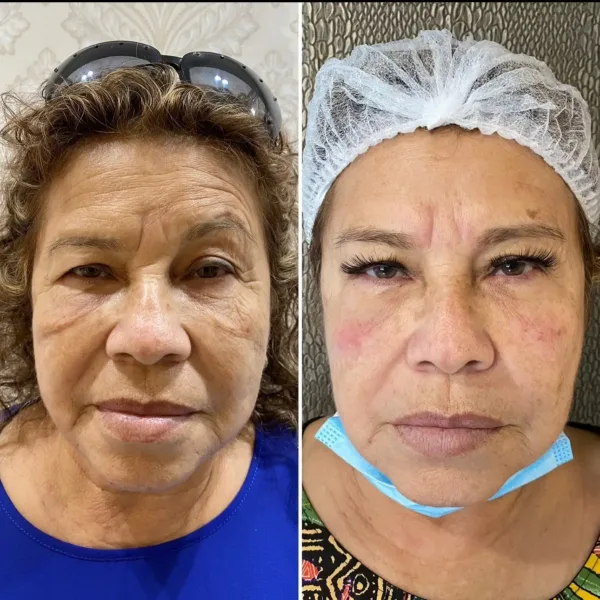 CFU Elife: Rejuvenecimiento facial y corporal no invasivo - Imagen 8