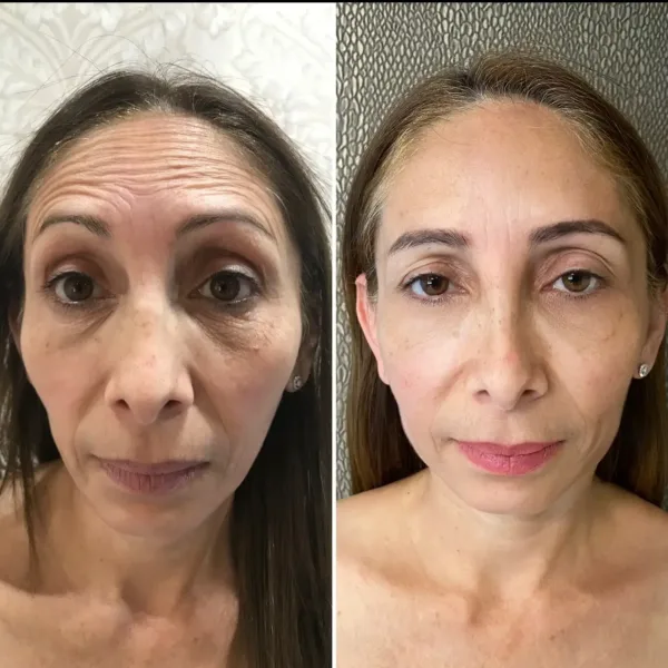 CFU Elife: Rejuvenecimiento facial y corporal no invasivo - Imagen 7
