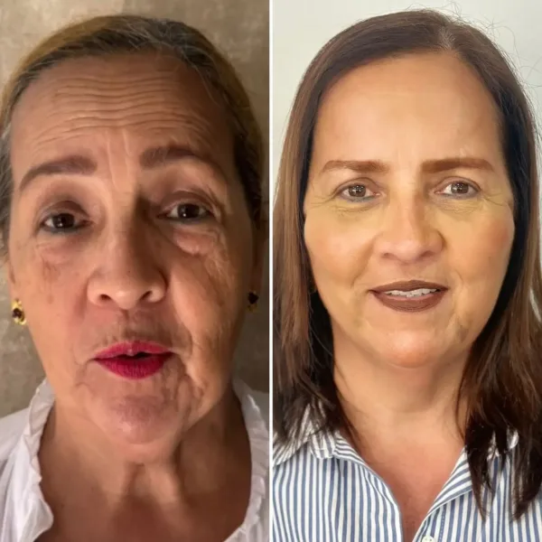 CFU Elife: Rejuvenecimiento facial y corporal no invasivo - Imagen 3