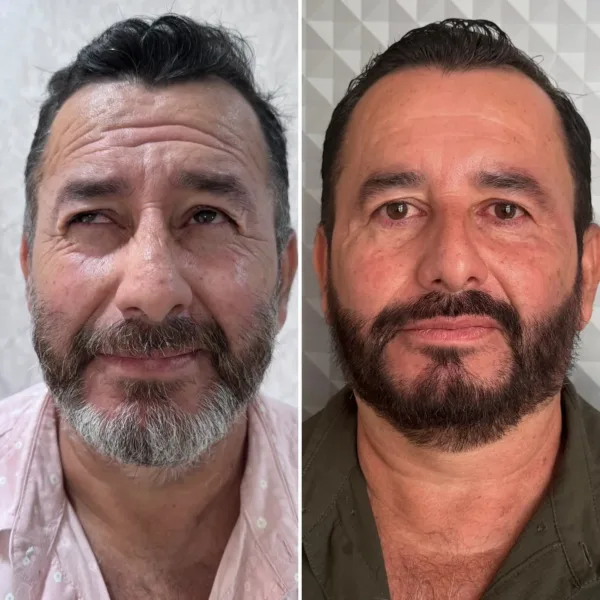 CFU Elife: Rejuvenecimiento facial y corporal no invasivo - Imagen 5