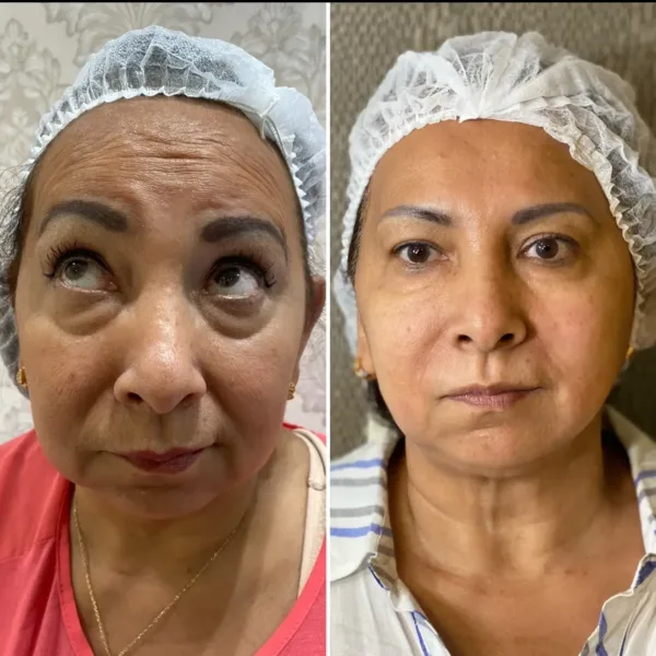 CFU Elife: Rejuvenecimiento facial y corporal no invasivo - Imagen 6