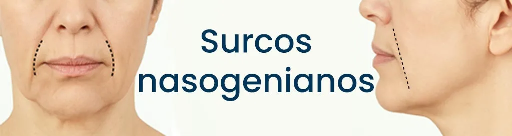surcos nasogenianos
